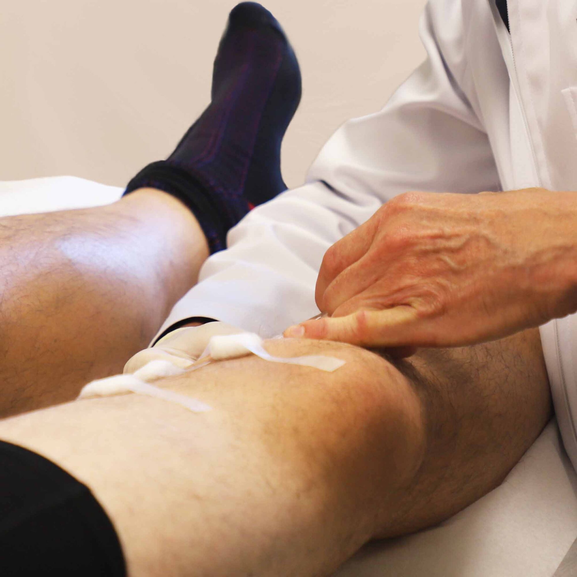 Varicose Vein Treatment – Sclerotherapy